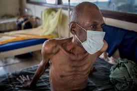 Becoming very ill with TB disease